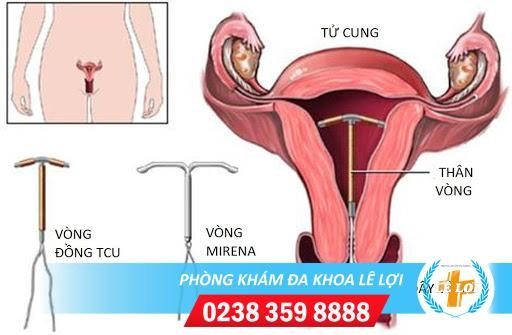 Tháo vòng tránh thai những điều bạn nên biết