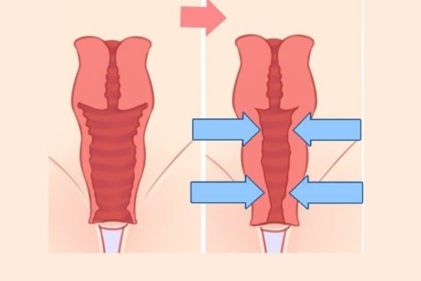 Thu hẹp âm đạo giải pháp giữ lửa hôn nhân bền lâu