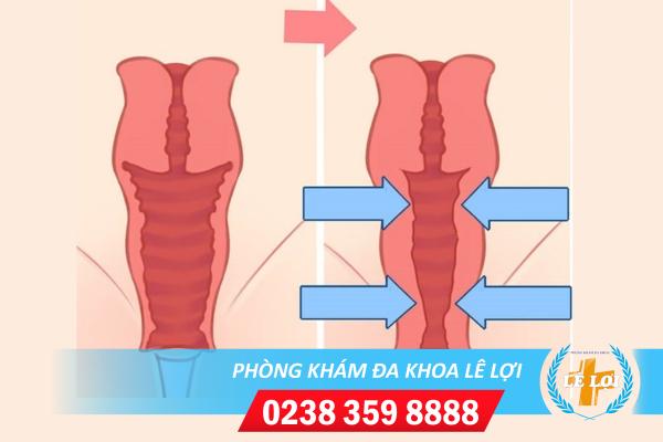 Thu hẹp âm đạo giải pháp giữ lửa hôn nhân bền lâu