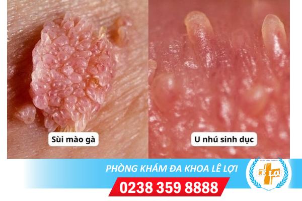 Nhú gai sinh dục cảnh báo bệnh gì?