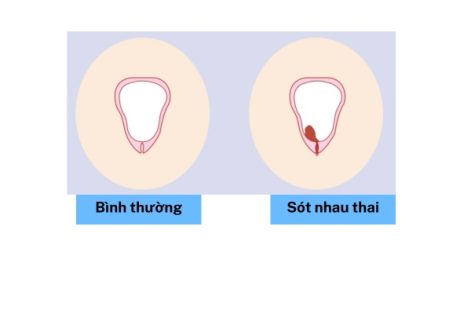 Sót nhau thai nguy hiểm không dấu hiệu nhận biết