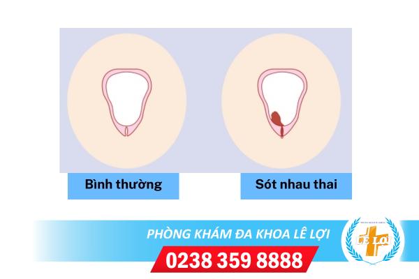 Sót nhau thai nguy hiểm không dấu hiệu nhận biết