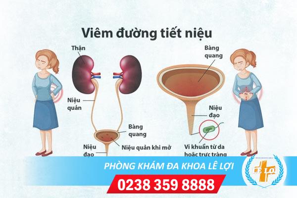 Dấu hiệu viêm đường tiết niệu ở nữ và cách điều trị tối ưu