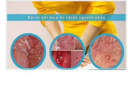 Hột le bị nổi mụn là bị bệnh gì?