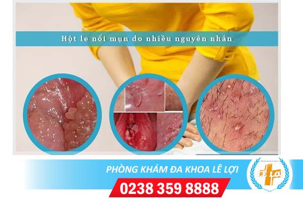 Hột le bị nổi mụn là bị bệnh gì?