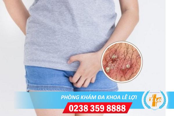 Nổi mụn âm đạo cảnh báo bệnh nguy hiểm gì?