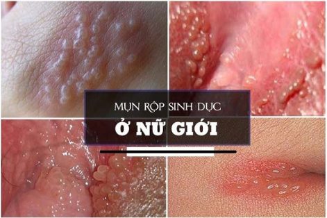 Chữa mụn rộp âm đạo thế nào hiệu quả?