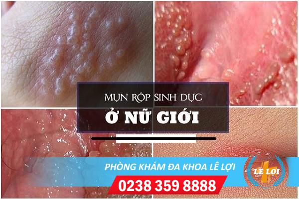 Chữa mụn rộp âm đạo thế nào hiệu quả?