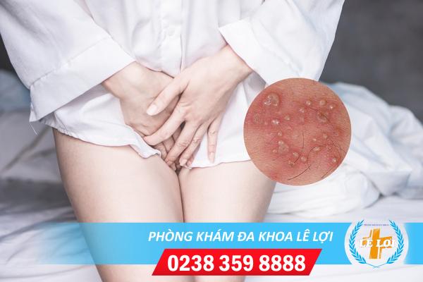 Biện pháp điều trị mụn rộp âm đạo tốt nhất hiện nay