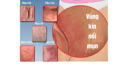 Nguyên nhân gây mụn vùng kín và cách điều trị