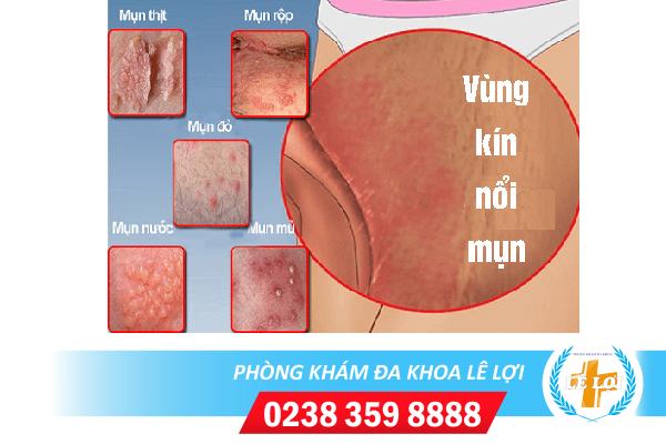 Nguyên nhân gây mụn vùng kín và cách điều trị