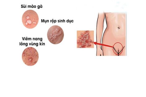 Nổi mụn ở mép âm đạo vùng kín là bị gì?