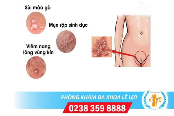 Nổi mụn ở mép âm đạo vùng kín là bị gì?