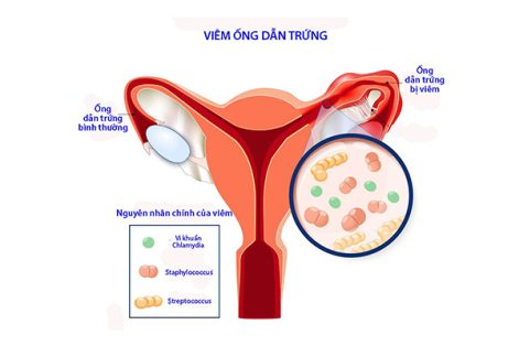 Những thông tin cần biết về bệnh viêm ống dẫn trứng