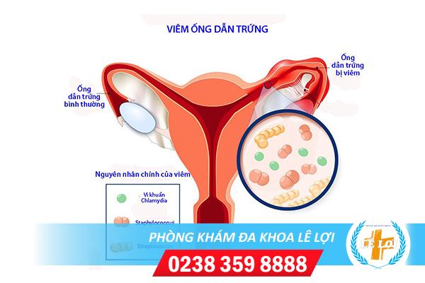 Những thông tin cần biết về bệnh viêm ống dẫn trứng