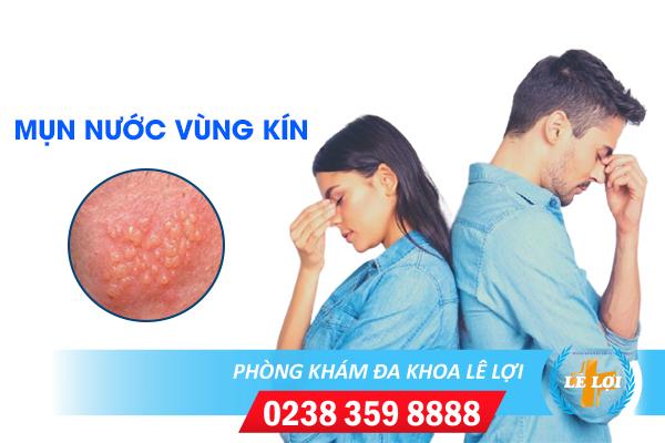 Những thông tin cần biết về mụn nước ở vùng kín