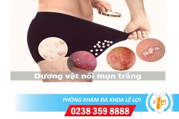 Nổi hạt trắng cậu bé là bị bệnh gì?