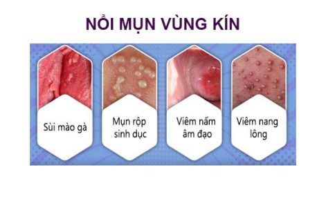 Nổi mụn vùng kín phải làm sao?