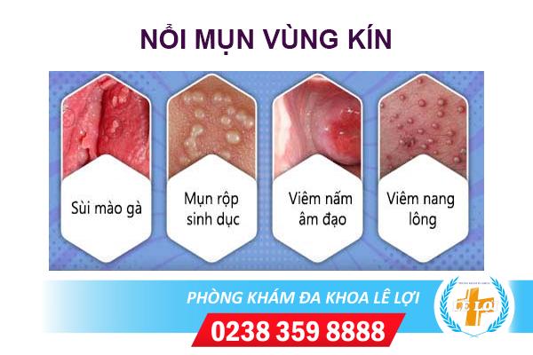 Nổi mụn vùng kín phải làm sao?