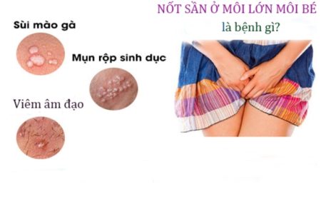 Nốt sần ở môi lớn môi bé nguy hiểm không?