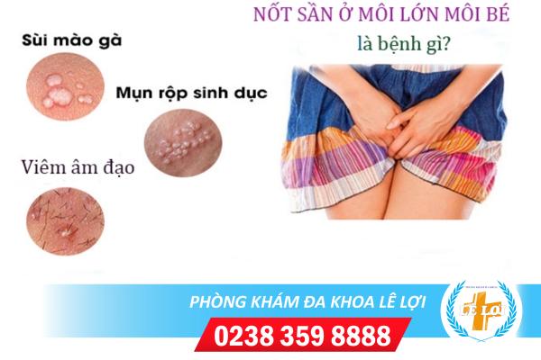 Nốt sần ở môi lớn môi bé nguy hiểm không?