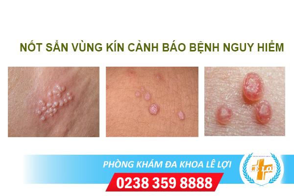 Nốt sần ở vùng kín là bị bệnh gì?