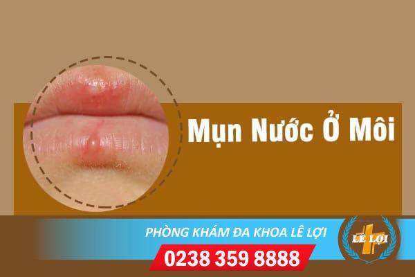 Thông tin về tình trạng mụn nước ở môi