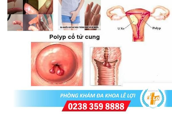 Ra khí hư ngứa là bị gì?