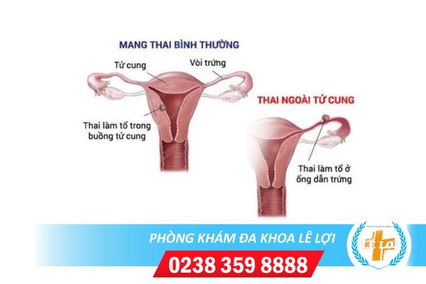 Dấu hiệu nhận biết có thai ngoài tử cung