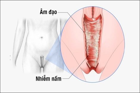 Phương pháp điều trị nấm âm đạo hiệu quả