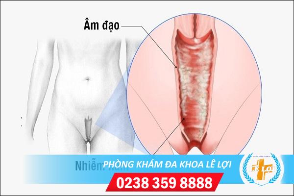 Phương pháp điều trị nấm âm đạo hiệu quả