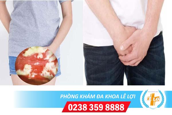 Chữa trị nấm vùng kín ở đâu hiệu quả?