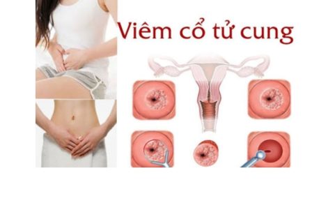 Dấu hiệu viêm cổ tử cung nặng và nhẹ