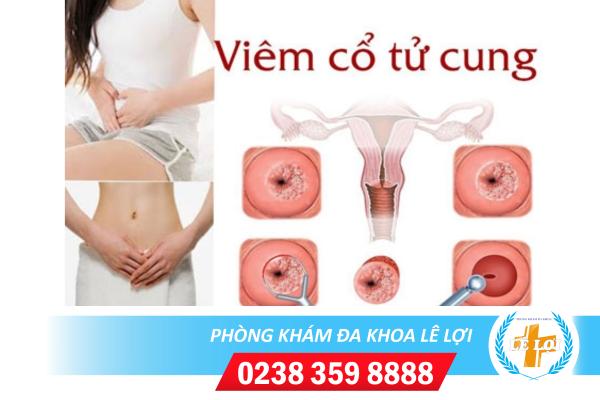 Dấu hiệu viêm cổ tử cung nặng và nhẹ