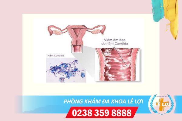 Viêm nhiễm âm đạo nguy hiểm không?