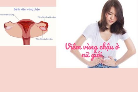 Viêm vùng chậu có ảnh hưởng gì ?