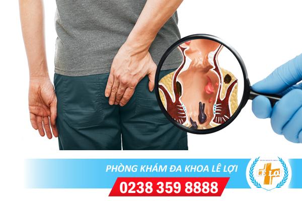 Bị trĩ phải làm sao?