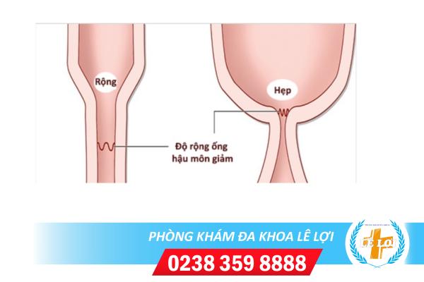 Hẹp hậu môn là bệnh gì nguy hiểm không?