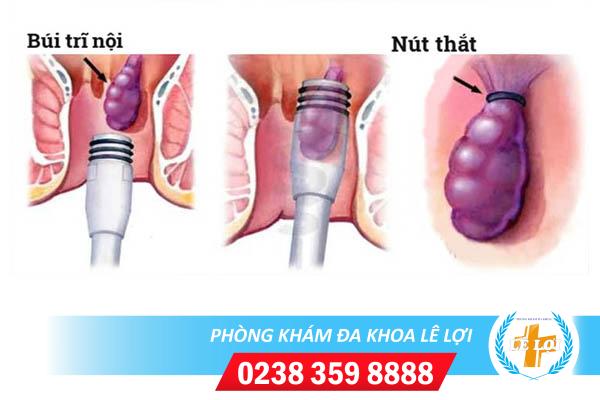 Thắt búi trĩ là gì có hiệu quả không?