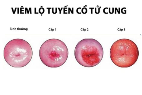 Nguyên nhân viêm lộ tuyến cổ tử cung