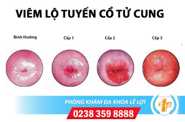 Nguyên nhân viêm lộ tuyến cổ tử cung