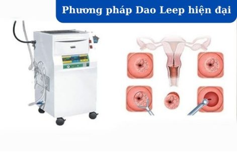 Điều trị viêm lộ tuyến cổ tử cung – Phương pháp áp lạnh hay dao leep?