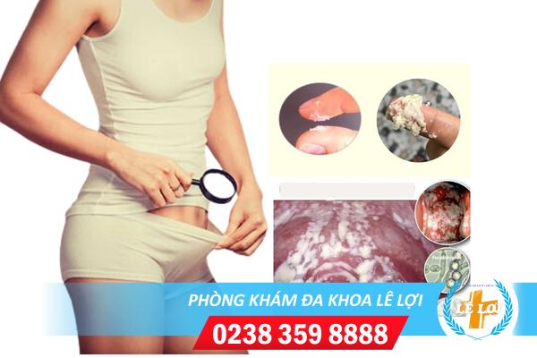 Dịch âm đạo trông như bã đậu là bị gì?