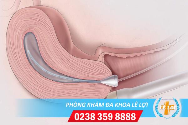 Những điều bạn cần biết về siêu âm phụ khoa đầu dò