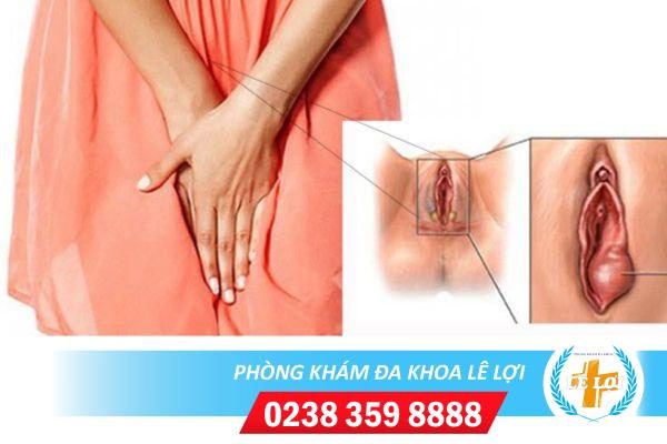 Sưng âm đạo do đâu? Cách điều trị hiệu quả