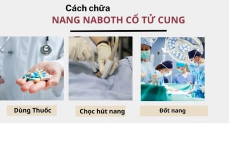 Cách chữa nang naboth cổ tử cung hiệu quả