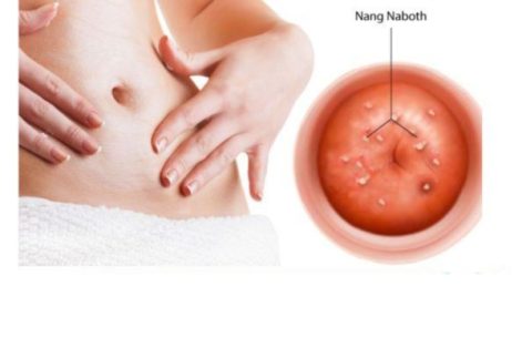 Bị nang naboth cổ tử cung điều trị sao cho hiệu quả?