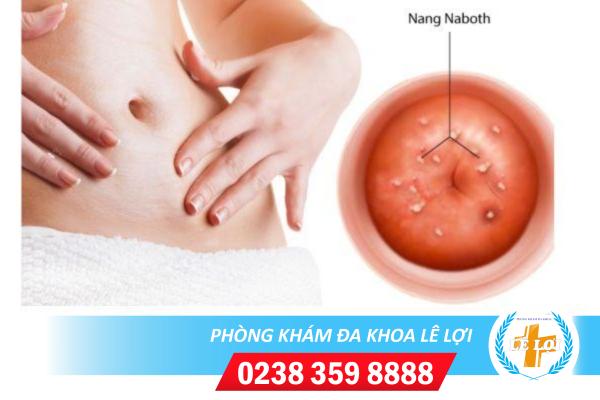 Nhận Biết Bệnh Nang Naboth Cổ Tử Cung Bằng Cách Nào?